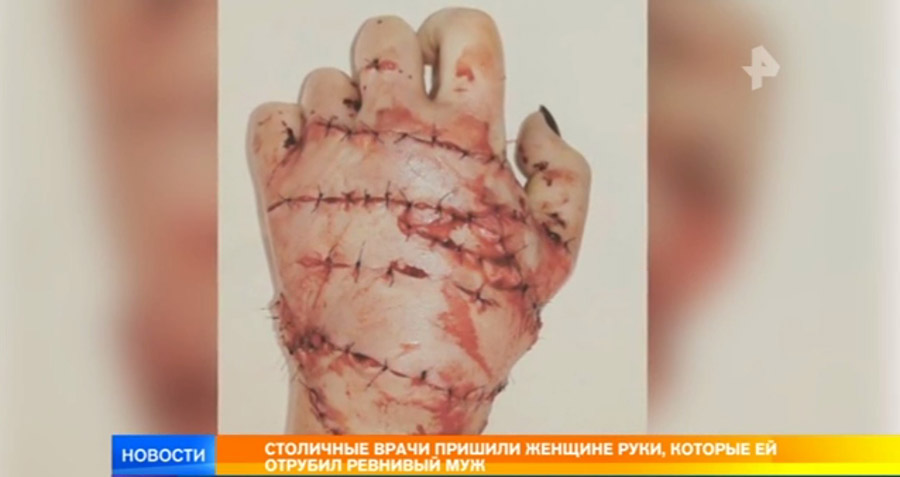 Хирурги почти 10 часов пришивали женщине руки, которые ей отрубил ревнивый муж