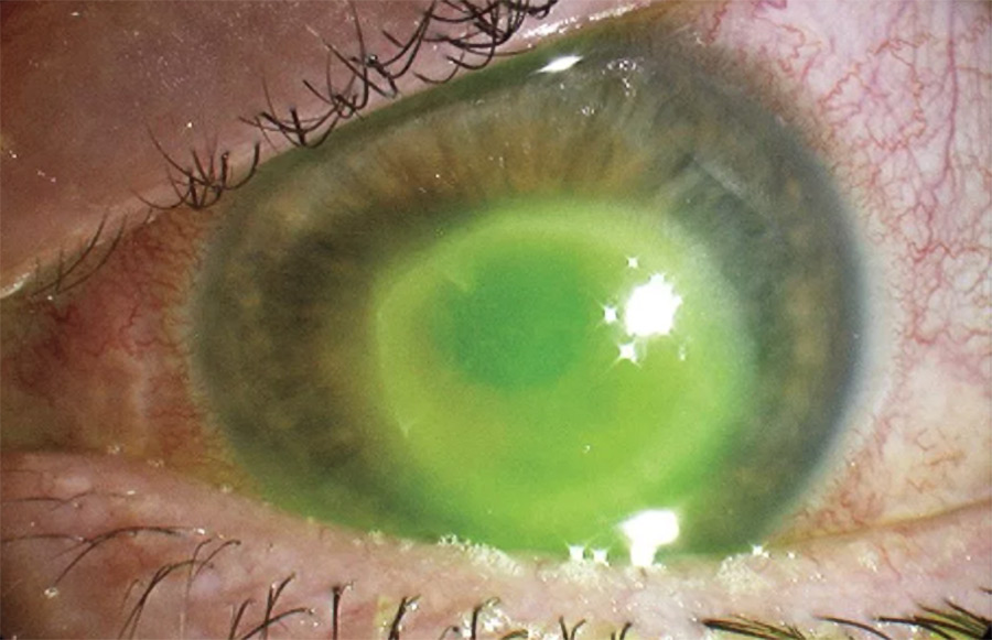 Пациентка ослепла на левый глаз из-за того, что постоянно принимала душ в линзах