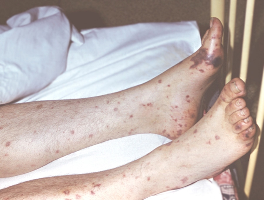 Менингококковая инфекция — как избежать? Рассказывает бобруйский специалист