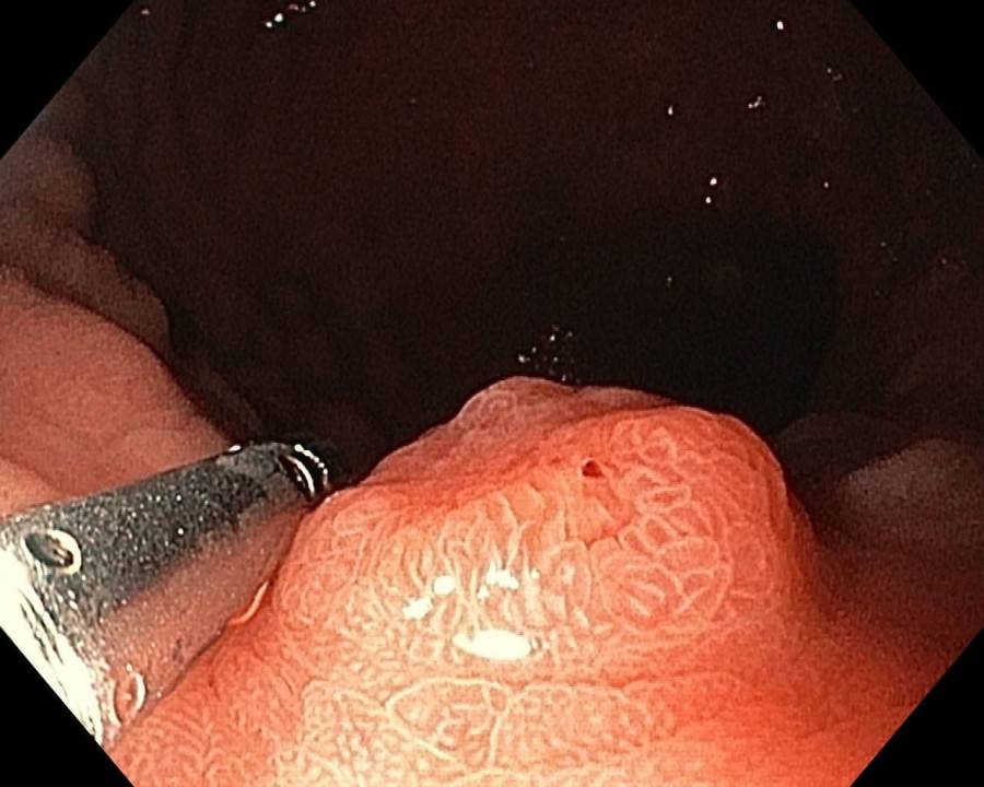 Во время колоноскопии  обнаружен полип в толстом кишечнике. Могилевская областная клиническая больница.