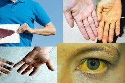 Гепатит А: болезнь грязных рук. Как уберечь себя и близких?