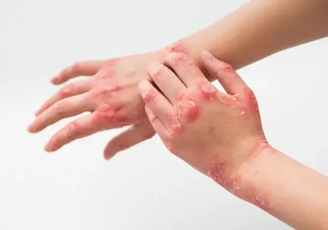 Ожоги 40% тела получил восьмимесячный ребенок в Осиповичах 